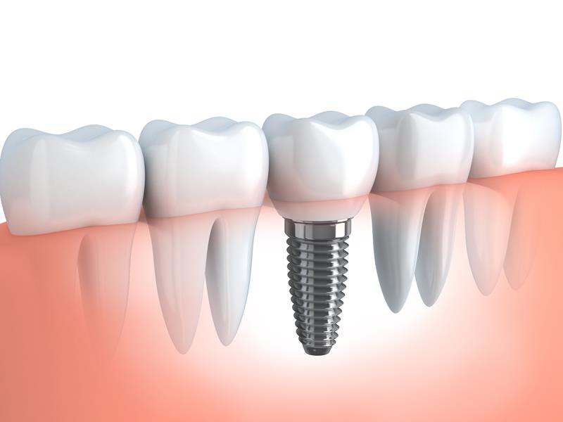Dental Implants  Geneva, NY 