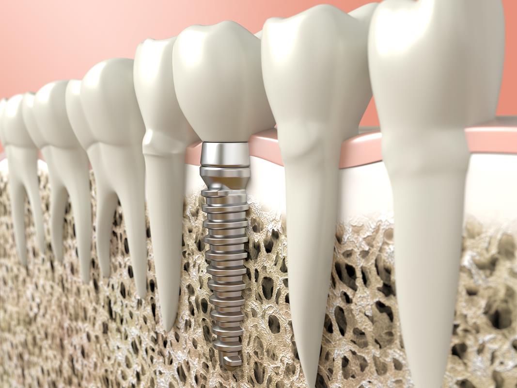 Dental Implants  Geneva, NY 